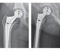 X-ray measurement of the angles of cup anteversion and stem antetorsion  of the hip joint prosthesis