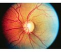 Аналіз ефективності застосування Травінору® в лікуванні первинноївідкритокутової глаукоми