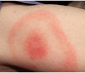 Lyme disease in childhood: look at the problem and clinical case