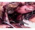Опыт хирургического лечения грыж пищеводного отверстия диафрагмы лапароскопическим доступом