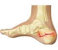 The clinical aspects of diagnosis and treatment of intra-articular  calcaneal fractures