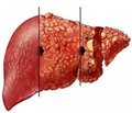 State of endogenous intoxication and immune-inflammatory response in patients with alcoholic liver cirrhosis associated with non-alcoholic fatty liver disease