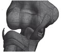 Biomechanical definition  of the elbow stability at the radial head fractures combined  with collateral ligament injury