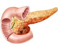 Формула ентерального харчування у хворих  на тяжкий гострий панкреатит