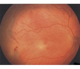 Визначення рівня фактора росту ендотелію судин у сльозі недоношених дітей із групи ризику розвитку ретинопатії недоношених