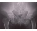 Поєднана патологія кісткової тканини: остеопороз та остеомаляція в пацієнтки із хворобою Паркінсона (Опис клінічного випадку)