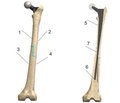 Дослідження напружено-деформованого стану в системі «імплантат — кістка» на моделі алокомпозитного ендопротеза проксимального відділу стегнової кістки