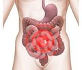 Clinical case in a female patient with irritable bowel syndrome
