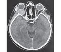 X-ray techniques in the diagnosis of orbital pathology