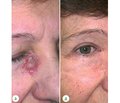 Mohs micrographic surgery for high-risk basal cell carcinoma