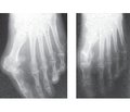 Differential approach to surgery method for hallux valgus treatment