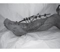 Case of successful reconstruction of critically damaged lower extremity