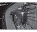 Роль нестабільності сухожилка  довгої головки біцепса в розвитку ротаторної артропатії плечового суглоба