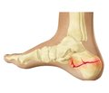 Analysis of the current state of treating intra-articular factures of the calcaneus