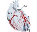 Шкала стратифікації сприятливого й несприятливого прогнозу  й виникнення кардіальних подій при гострому інфаркті міокарда залежно від ступеня стенозу вінцевих артерій та особливостей диференційованого впливу різних уражених артерій  на перебіг захворювання впродовж двох років