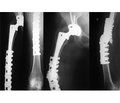 Modern trends in the treatment of periprosthetic femur fractures