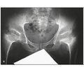 Impact of comorbidity on the results of total hip and knee replacement in patients with osteoarthritis in spondyloepiphyseal dysplasia