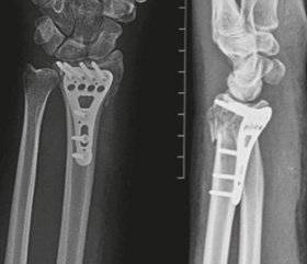 Фіксація волярною пластиною тяжких переломів променевої кістки за типом 23-C AO. Аналіз причин ускладнень лікування