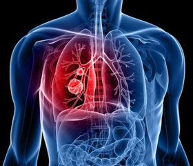 Цукровий діабет і туберкульоз: проблема синтропії коморбідної патології