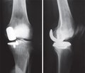Результати одновиросткового ендопротезування колінного суглоба