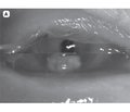 Дослідження ефективності операції лікувальної автотрансплантації склери при деструктивних ураженнях рогової оболонки ока травматичного походження