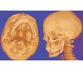 Сучасні можливості та перспективи застосування CAD/CAM технології в лікуванні хворих із дефектами і деформаціями кісток лицевого черепа