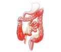 Onset of Crohn’s Disease by Symptoms of Acute Appendicitis