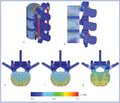 Экспериментальное биомеханическое обоснование транспедикулярного спондилодеза с вертебропластикой на основе изучения конечно-элементной модели фрагмента позвоночного столба