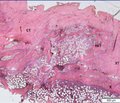 Spondylosis lumbalis formation in rabbits after bone graft and platelet-rich fibrin