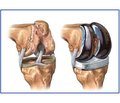 Сцинтиграфические количественные параметры операбельности при эндопротезировании у пациентов с посттравматическим остеоартрозом коленных суставов