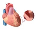 Казуистические маски инфаркта миокарда: постинфекционный, сепсис-ассоциированный