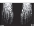 Корригирующий артродез I плюснеклиновидного сустава в лечении вальгусной деформации первого пальца стопы