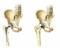 Hip Dislocation After Total Hip Arthroplasty