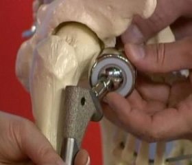 Особливості лікування переломів шийки стегнової кістки у пацієнтів в умовах селенодефіцитного регіону