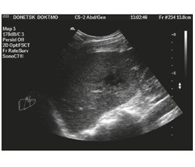 Ultrasonography in the Diagnosis of Posttraumatic Liver Abscesses and Control of Minimally Invasive Therapeutic Interventions