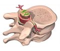 Симптоми травми спинного мозку