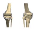 Study of relative deformations of the ligamentous apparatus of the knee joint in case of aplasia  of the cruciate ligaments and after their restoration (mathematical modeling)