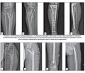 Disuse (post-mobilization) osteoporosis: literature review and clinical case series