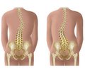 Association between bone turnover markers and leptin in girls with adolescent idiopathic scoliosis