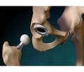 Features of hip replacement in severe types of dysplasia