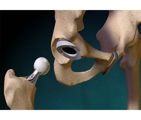 Features of hip replacement in severe types of dysplasia