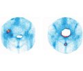 Діагностична роль остеосцинтиграфії  у хворих на ревматоїдний артрит  при ендопротезуванні кульшових суглобів