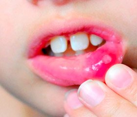 Результаты изучения гельминтоносительства как сопутствующей патологии у детей с герпетическим стоматитом