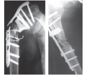 Проблемні питання сучасного остеосинтезу переломів плечової кістки