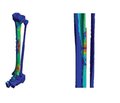 Investigation of the stress-strain state of the tibia model with a fracture of the middle third of the tibia in different variants of osteosynthesis under conditions of increasing compressive load on the implant-bone system