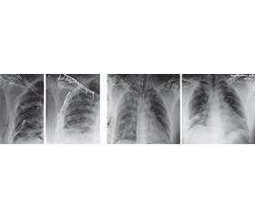 Диференційний підхід при лікуванні пацієнтів із поєднаними переломами ключиці та ребер