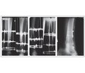 Modern Approach to Treatment of Chronic Osteomyelitis in Patients with Iodine Deficiency Using High-Intensity Laser