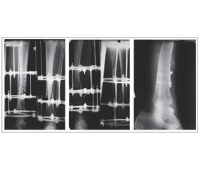 Сучасний підхід до лікування хронічного остеомієліту у хворих з дефіцитом йоду з використанням високоінтенсивного лазерного випромінювання