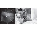 Магнітно-резонансна томографія в плануванні ендоскопічного доступу для денервації поперекових дуговідросткових суглобів