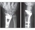 До питання лікування переломів променевої кістки в типовому місці